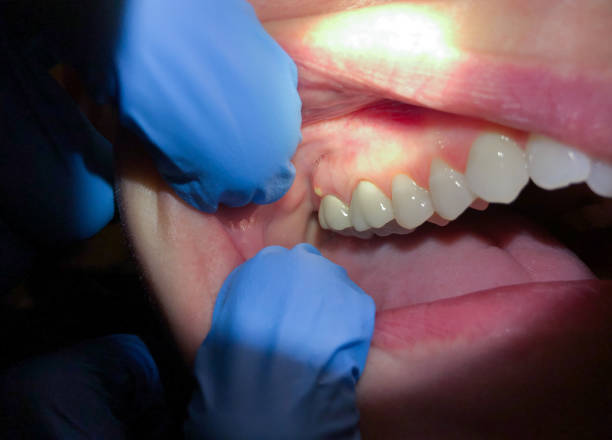 Best Dentist for Tooth Abscess  in Lake Worth, TX